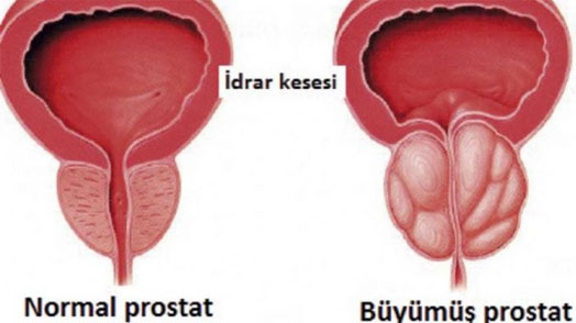 prostat hastalıkları